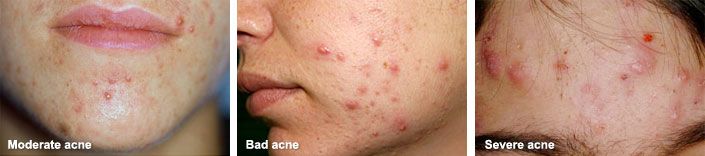 photos of moderate, bad, and severe acne types