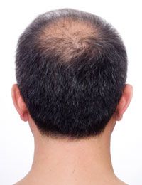 hair loss