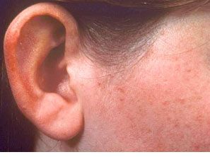 mild acne treatment