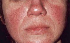 Photo of typical rosacea on face