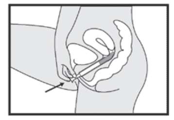 Vaginal cream/gel insert diagram